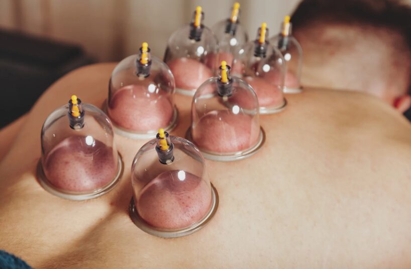 cupping therapy oak haven